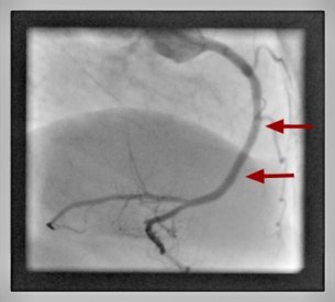 Percutane Koronarintervention Herzkranzgefäßeinengung behandelt Kardiologie Garbsen