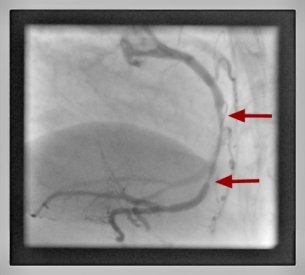 Percutane Koronarintervention Herzkranzgefäßeinengung Kardiologie Garbsen